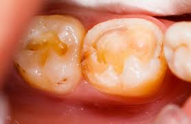 Il est généralement placé après le nom et s'accorde les enfants savent bien que s'ils mangent trop de bonbons ils auront des caries. Plombage Tombe Bucco