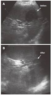 Image result for Splenic Abscess
