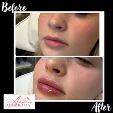 Botox results ✨ #owassooklahoma #owassobotox #botoxbeforeandafter  #owassoinjectables #owassobeauty #tulsainjectables #tulsainjector