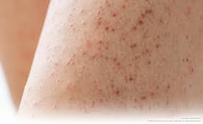 Image result for Keratosis pilaris