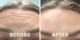 Skin perfect medical aestheticsuniversity of california, los angeles. Skin Care Whittier Los Angeles Skin Perfect Medical Spa