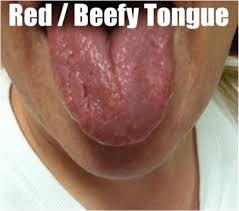 It can also indicate several other ailments, such as: What Your Tongue Tells You About Your Thyroid Hypothyroid Mom