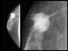 Many cancers are not visible on ultrasound. The Radiology Assistant Pathology Of The Male Breast