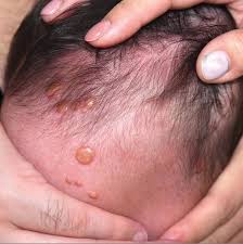 Image result for yellow scabs on the face in children