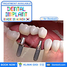 Memang begitu adanya, mengingat ketika seseorang mengalami sakit baik ringan ataupun kronis pasti harus mendapatkan penanganan yang lebih lanjut dan membutuhkan biaya. Blog Archives Dentist Malaysia
