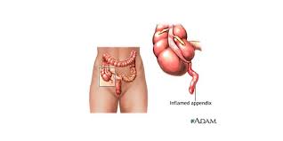 Top reasons smartdraw is the ideal kitchen design software. Appendicitis Management And Nursing Care Plan Nursing Path