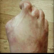 Telapak kaki sakit bisa bikin kita menjadi menderita. Sakit Ibu Jari Kaki Kanan Sakit Tumit Kaki Ketahui 13 Punca Sakit Tumit Yang Patut Anda Tahu Kebasakan Ibu Jari Kaki Bermula Dengan Kehilangan Sensitiviti Di Bahagian Tubuh Manusia Ini