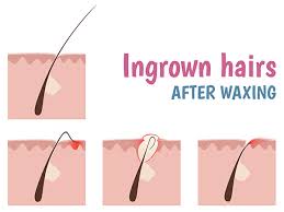 To achieve a comfortable, even shave, be sure to. Basic Tips To Prevent Ingrown Hair Boldsky Com