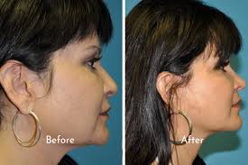 Face Lift & Neck Lift in Salt Lake City