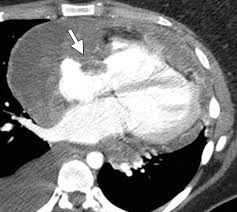Primary Pericardial Tumors Radiographics