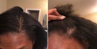 Nizoral for hair loss is very effective because it contains ketoconazole. Best Seborrheic Dermatitis Shampoos Skinpractice