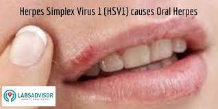 If you are sexually active, worried about hiv or other stds and want peace of mind, we strongly recommend you get a full std screen or an hiv test. 50 Off On Hsv Test Cost In India Starting From 700 Only