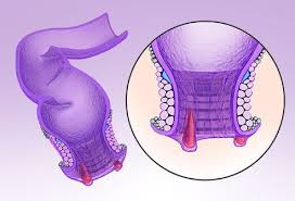 How to convert dollar to rupees ! Anal Fissure Symptoms Causes Treatment Healing Time
