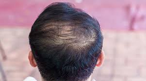 Searching for the best hairstyles for men with thin hair? Best Treatments For Thinning Hair For Men And Women Venus Treatments