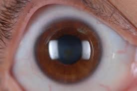 Late Onset Corneal Haze After Corneal Cross-Linking For Progressive  Keratoconus - Sciencedirect