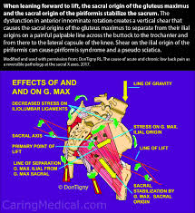 Pain from piriformis syndrome can affect your sleep quality, but there are steps you can take that will improve both. Piriformis Syndrome And Sciatica Pain Caring Medical Florida