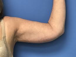 Eat small, healthy meals throughout the day (every two to three hours) that include whole grains, dark leafy greens and no processed foods or sugar. How To Get Rid Of Flabby Arms Loose Arm Skin Dr Ali