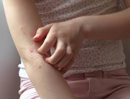 Image result for dermatitis contacta children