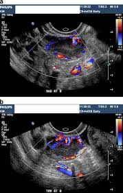 Image result for corpus luteum sonography)