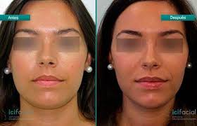 Voy a solicitar la beca cuando (ir) a franklin hall. Bichectomia Y Eliminacion De Papada Dr Macia Colon Icifacial Madrid