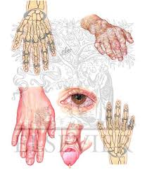 Although often described as such, it is not a costochondritis 9. Hand Involvement In Gouty Arthritis And Reiter Syndrome