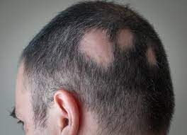 The scientific term for aga is androgenic alopecia. Baricitinib Enhances Hair Regrowth For Alopecia Areata Patients
