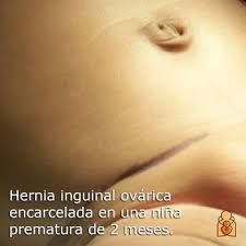 Hernia Inguinal En Bebes Y Ninos Healthychildren Org