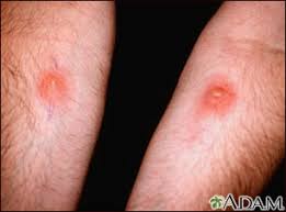 Positive tb skin test versus allergic reaction these. Skin Testing Ppd R Arm And Candida L Medlineplus Medical Encyclopedia Image
