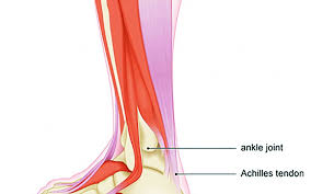 Treatment Options For Chronic Achilles Tendon Disorders