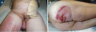 Fournier gangrene typically affects men above 50 years of age. Management Protocol For Fournier S Gangrene In Sanitary Regime Caused By Sars Cov 2 Pandemic A Case Report