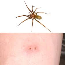 Piqures D Insectes Comment Reconnaitre Quel Insecte Vous A Pique Piqure Insecte Piqure Araignee Piqure De Tique