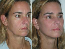 Pin On Sagging Jowls Regimens For Lifting And Tightening