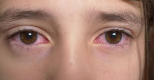 Conjunctivitis or more commonly known as pink eye happens when the conjunctiva is irritated in one's eyeball and is often caused by an infection or other allergies. Not All Red Eyes Are Pink Eye Potomac Pediatrics Rockville Md