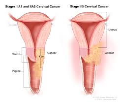 Cervical Cancer Treatment Pdq Pdq Cancer Information Summaries Ncbi Bookshelf
