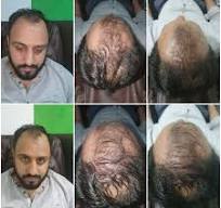 Hair Transplant Islamabad | Best Clinic in Pakistan - Hairhub