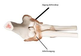 8,930 likes · 14 were here. Freie Gelenkkorper Am Ellenbogen Arthrowl Bunde