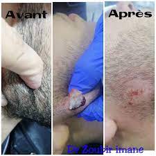 Cette gaine entoure les articulations et contient une sorte d'huile (le liquide synovial) qui. Les Kystes Sebaces Sont Les Kystes Cutanes Les Plus Frequents Forme Dans Les Glandes Sebacees Et Cree Par L Accumulation De Sebum Sous La Peau La Substance Grasse Qui Protege L Epiderme Un Kyste