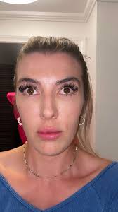 Blepharoplasty surgery preparation and recovery tips