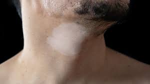 Image result for Postinflammatory Hypopigmentation