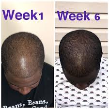 We're the leading experts in hair regrowth, replacement, restoration, and styling with decades of experience. Hair Growth Secrets Using Natural Remedies For Longer Hair Natural Hair Regrowth Hair Growth Oil Hair Loss Growth