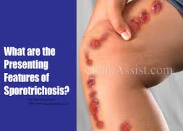 The fungal infection caused by the sporothrix schenckii fungi is known as sporotrichosis. What Are The Presenting Features Of Sporotrichosis Can Sporotrichosis Go Away On Its Own