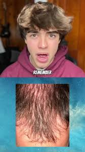 Prevent Hair Loss with Growplex