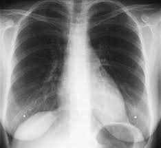 Main Thorax
