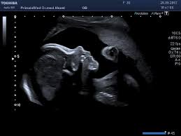 Der altersdurchschnitt der werdenden mütter steigt. Frauenheilkunde Und Pranatale Medizin Dr Med Annette Mosel Osnabruck