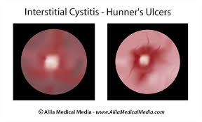 Image result for Interstitial Cystitis