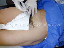 Many patients become symptomatic after the first 1 to 2 years and crossover to. Alternatives To Sports Related Groin Pain Surgery Caring Medical Florida
