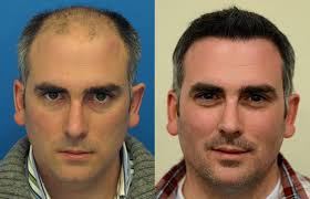 When doing your research, it helps to find a clinic where the doctor will spend time explaining not only the benefits of your procedure, but the side. Hair Transplant Incredible Hair Transplant Surgery Results
