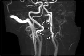 Saccular aneurysms of the internal carotid artery (ica) trunk and posterior communicating when there is significant residual clot inside the ventricles, evd or repetitive lumbar the optic and carotid cisterns are then opened. Pathology Of The Carotid Space Insights Into Imaging Full Text