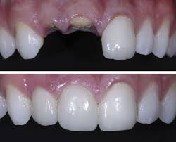 Root canal treatment on a live. 18 Before And After Ideas Smile Everyday Dental Veneers Dental