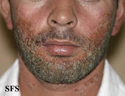 What is an ingrown hair? Ingrown Hair Ingrown Hair Under Lip